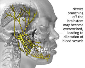 Best Migraine specialist in North Delhi