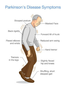 best-parkinsons-specialist-in-north-delhi